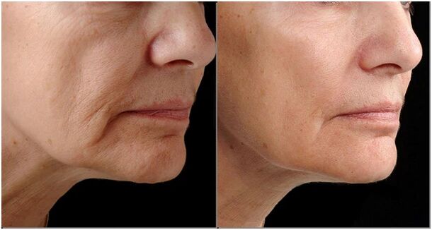 Before and after the rejuvenation of the laser
