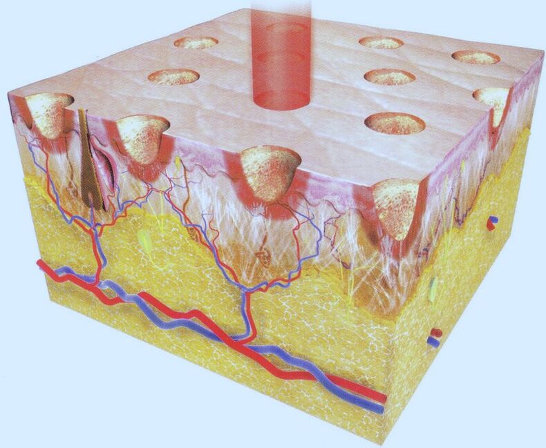 The laser burns some of the skin cells, forcing their environment to increase regeneration. 